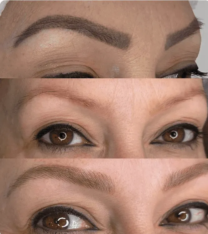 Evolução do Protocolo ReBrow: micropigmentação antiga escura, remoção a laser e novo desenho fio a fio